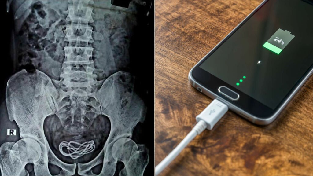 Man accidentally swallows a 2ft long mobile charger