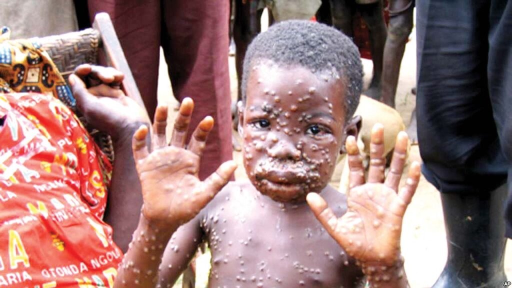 Monkeypox: what is it, and why is it spreading over the globe?
