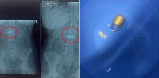 Lock Successfully Extracted Using Minimally Invasive Technique