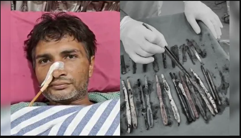 Doctors Remove 29 Spoons and 19 Toothbrushes from Patient’s Stomach in Ghaziabad Doctors remove spoons toothbrushes stomach