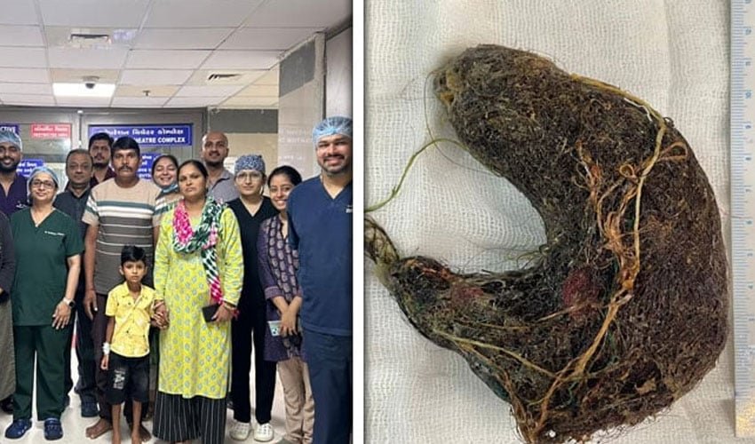 Ahmedabad Doctors Perform Rare Surgery to Remove Trichobezoar in Child Doctors remove richobezoar