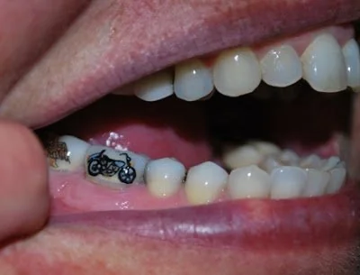 Rising Trend of Tooth Tattoos Sparks Dental Health Concerns