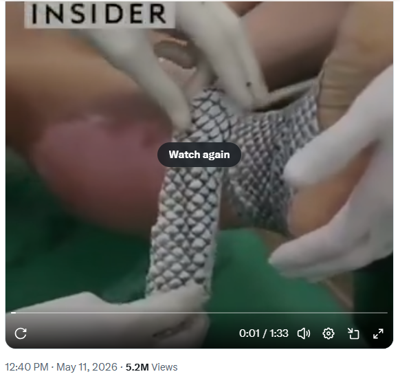 Brazilian Scientists Use Fish Skin to Treat Burns in Innovative Medical Breakthrough Brazilian Scientists Use Fish Skin to Treat Burns in Innovative Medical Breakthrough
