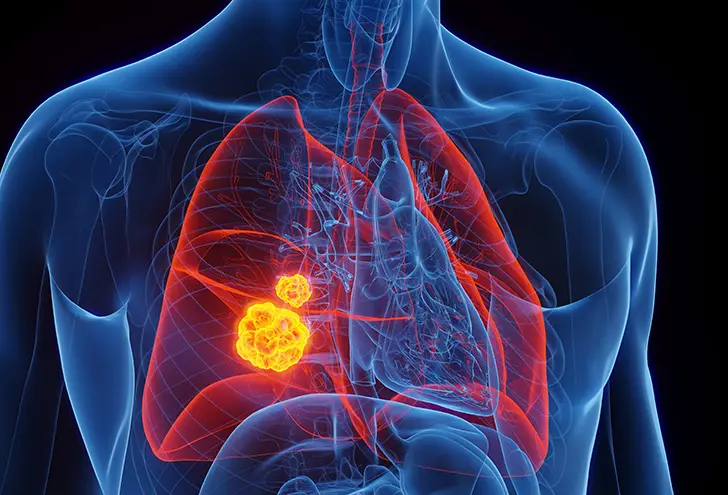 New Lung Cancer Therapy Shows Encouraging Results in Major Study